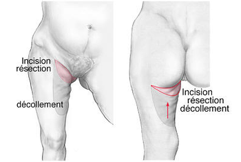 lifting cuisse