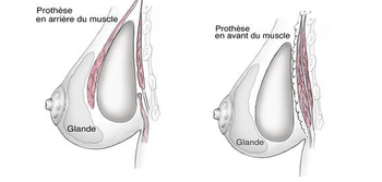 protheses mammaires 2