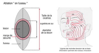 chirurgie cutanée