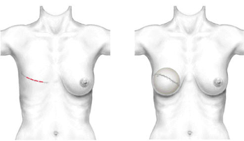 Reconstruction du Sein par Prothèse