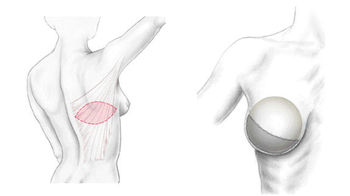 Reconstruction du Sein par Lambeau de Grand Dorsal