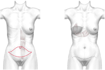 Reconstruction du Sein par Lambeau de Droit de l'Abdomen