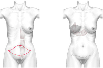 Reconstruction du Sein par Lambeau de Droit de l'Abdomen