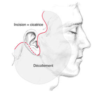 lift cervico facial