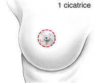 Sein 1 cicatrice