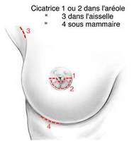 Protheses mammaires 1